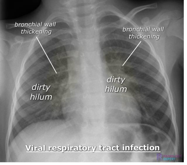 Chest X ray Child chest-x-ray-child